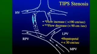 Doppler Evaluation of TIPS Shunts