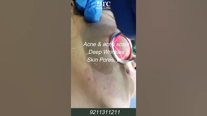 Fractional Laser Treatment | DTC Skin Clinic - DayDayNews