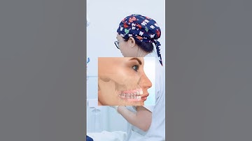 Không nên nhổ răng khi niềng | Lạc Việt Intech Niềng Răng #shorts