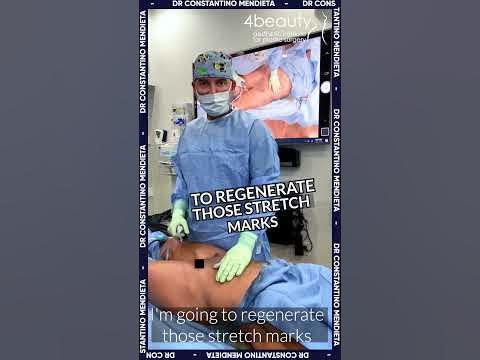 Regenerating Stretch Marks During Liposuction and BBL Surgery OR