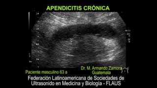 Apendicitis Crónica