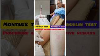 tuberculin skin test|positive Mantoux test #tb #shorts