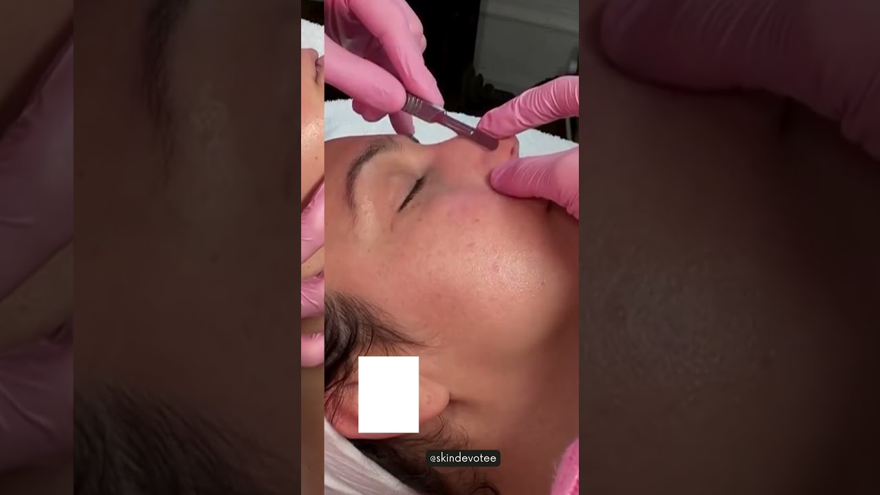 Professional Dermaplaning Facial | Goodbye Peach Fuzz!