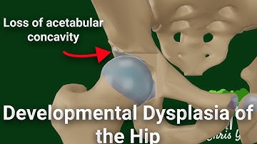 Pathology of Developmental Dysplasia of the Hip (DDH) (Animated)