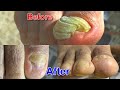 肥厚爪の施術【厚い爪のケア】（Thickened nails・THICK TOENAIL・두꺼워 손톱）　007