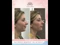 Non-surgical rhinoplasty