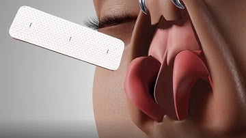 Septal Extension Graft with Bioresorbable Mesh