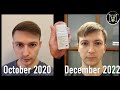 Oral minoxidil for hair loss my personal journey