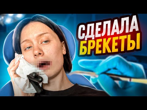 Видео: Уродливая Бетти снимает брекеты?