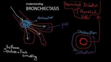 Understanding Bronchiectasis in 3 minutes @DR_Fairuz