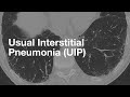 Usual interstitial pneumonia uip