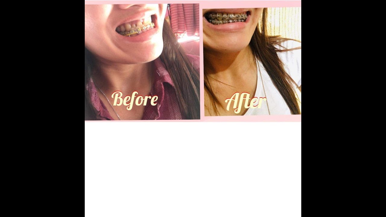 underbite braces journey