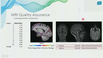 OHBM 2025 | Symposium | Chenyu Wang | A Real-world Clinical Validation for AI-based MRI Monitoring…