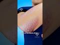 How Does Psoriasis Happen Shorts Viralvideo Skincare Creativelearning3d