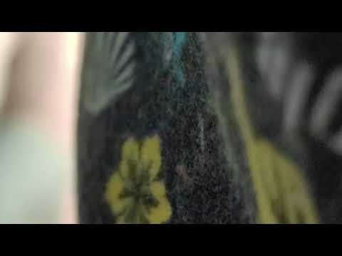 удаление многокамерной инфицированной тератомы крестцово-копчиковой области у девочки 6 лет