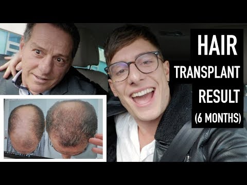 Hair Transplant After 6 Months Growth - Dad's Reveal! - 동영상