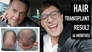Hair Transplant After 6 Months Growth - Dad's Reveal!