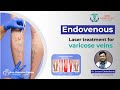 Endovenous laser treatment for varicose veins  dr sourav chakraborty