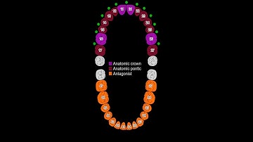 Exocad All on X Thimble bar design using EZ Scanbody