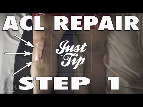 ACL REPAIR - STEP 1 TO HEALING STRONG AND FAST