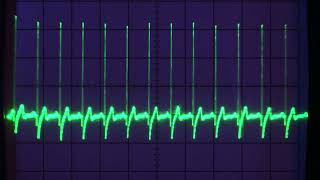 Fun with ECG from an at-home hobbyist perspective: exploring waveforms and understanding...
