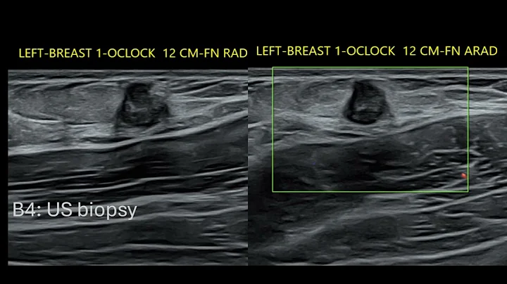 Pediatric Breast Case Review | Free Radiology CME