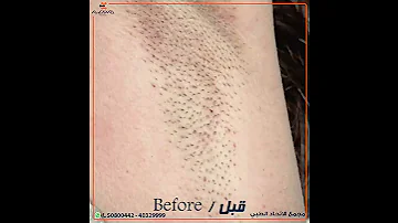 ليزر إزالة الشعر Laser Hair Removal 