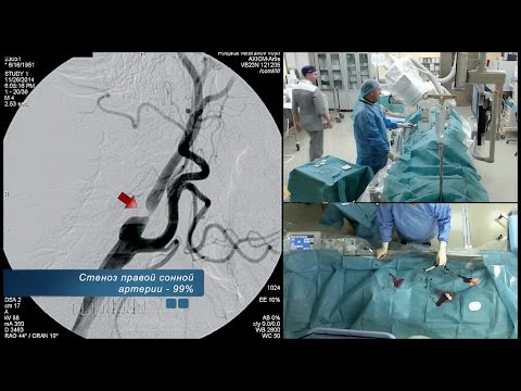 Video: Perifeersete Arterite Angioplastika Ja Stendi Paigutus