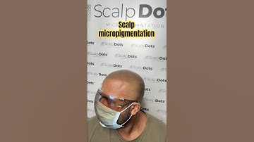 He got his new look with scalp micropigmentation #scalpmicropigmentation #smp #scalpdots