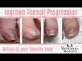 Ingrown Toenail Progression - How To Pedicure Tending to Toenails