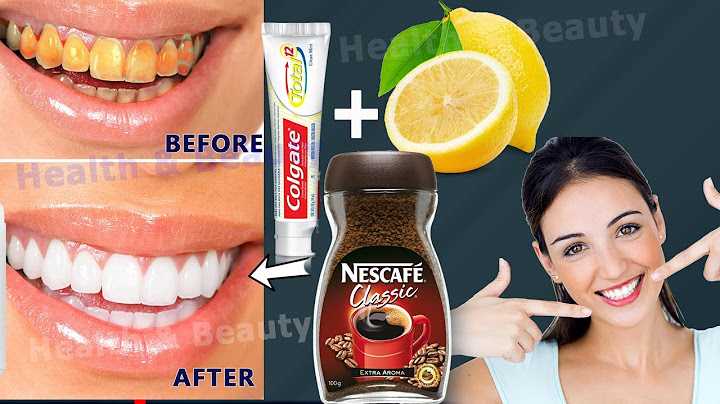 Whitening yellow teeth at home in 3 minutes naturally. Removal of dental stones