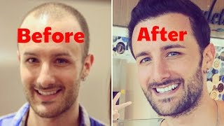FULL DISCLOSURE - Post Operation Hair Transplant Surgery