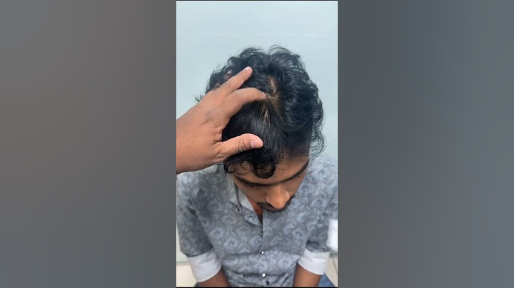মাএ ২০ বছরে চুল পড়ে যাওয়ার হতাশা | চুল পড়ার সমাধান | Hair Transplant Bangladesh #shorts #viralvideo