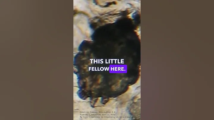 Scabies - The Itchy Parasitic Infection Caused By Human Itch Mites - RASH