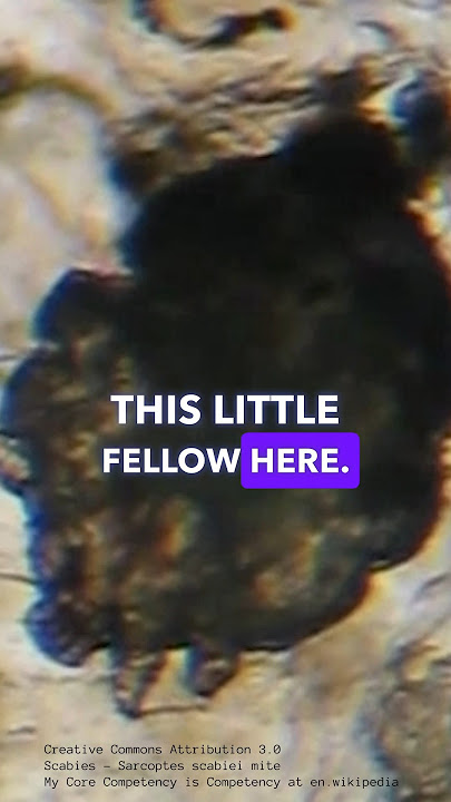 Scabies - The Itchy Parasitic Infection Caused By Human Itch Mites - RASH