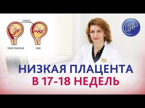 Низкая плацента в 17-18 недель это опасно? Дементьева С.Н.