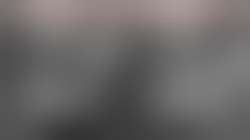 Staged Tooth Extraction & Site Bone Graft and Sinus Lift Bone Graft to Develop Dental Implant Site