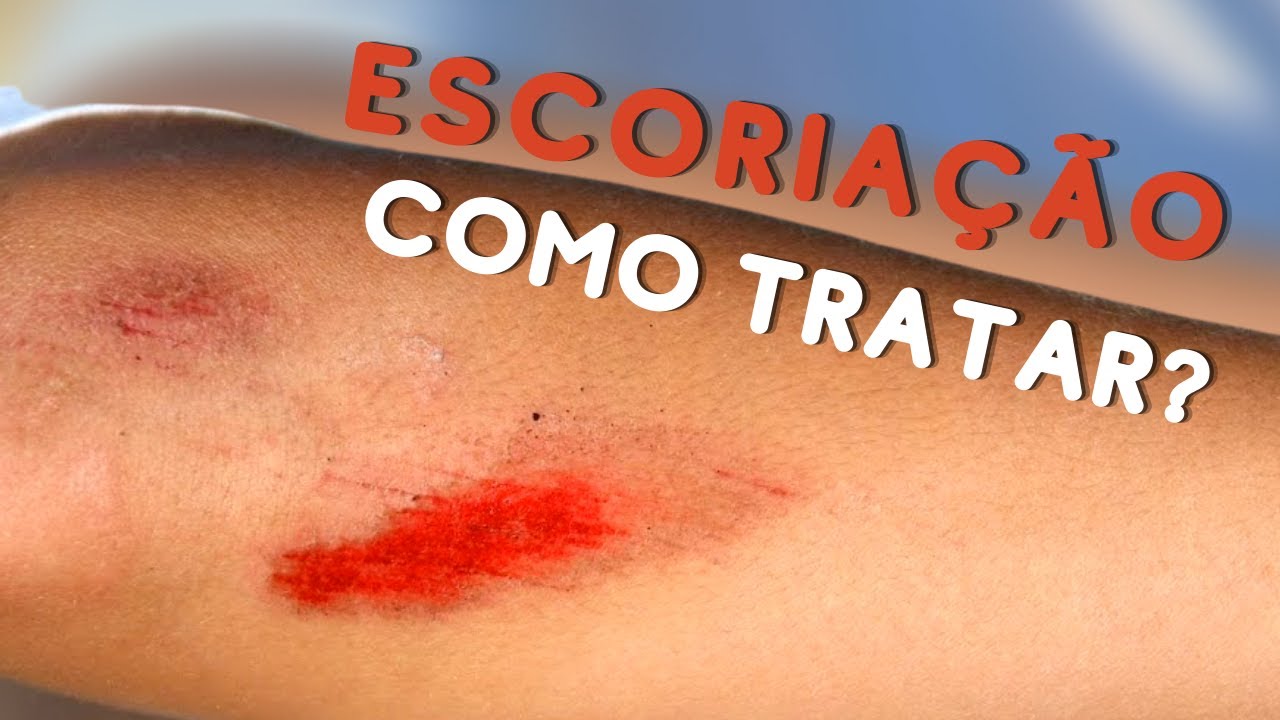 COMO TRATAR ESCORIAÇÃO YouTube COMO TRATAR ESCORIAÇÃO YouTube
