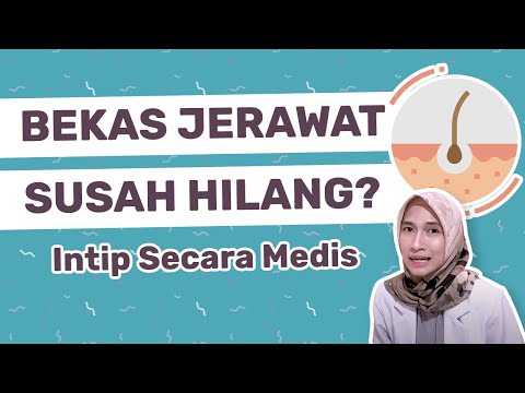 CARA MENGHILANGKAN BEKAS JERAWAT BOPENG | dr. Vania Utami