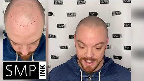 SMP Ink - Scalp Micropigmentation First Session Testimonial