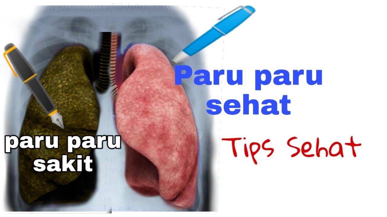 Cara Mengatasi Batuk Berdahak, Membersihkan Paru paru dari Asap dan