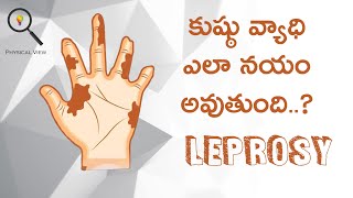 LEPROSY || కుష్ఠు వ్యాధి || LEPROSY IN TELUGU ||