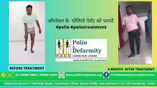 पोलियो पेशेंट कोऑपरेशन के फायदे घुटने से हाथ हटा  #polio #poliotreatment