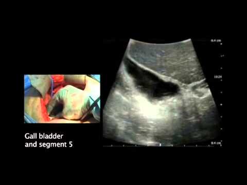 Intraoperative Ultrasound Imaging of the Liver - YouTube