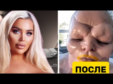 10 Знаменитостей До и После пластических Операции, которые окончились Кошмаром.