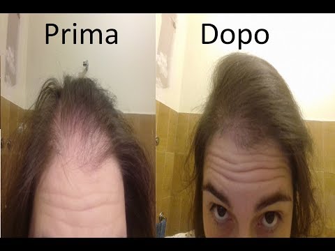 Video: Capelli Diradati: Trattamento, Vitamine E Altro