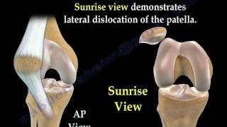 Patellar Dislocations - Everything You Need To Know - Dr. Nabil Ebraheim