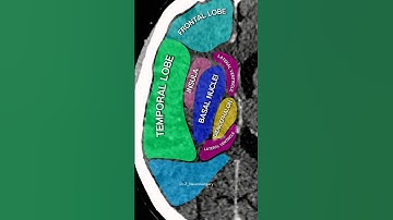 What a neurosurgeon sees on a CT scan of your brain. #medical #doctor #brain #anatomy #CT #radiology