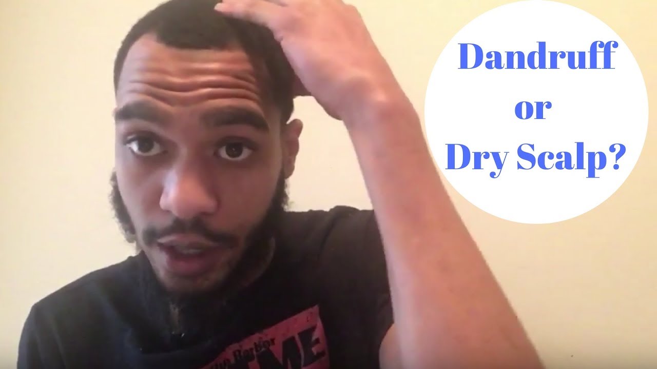 Do I have Dandruff or Dry Scalp + Test - YouTube