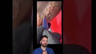 GOO #dermdoctor  #dermdoctor #shorts